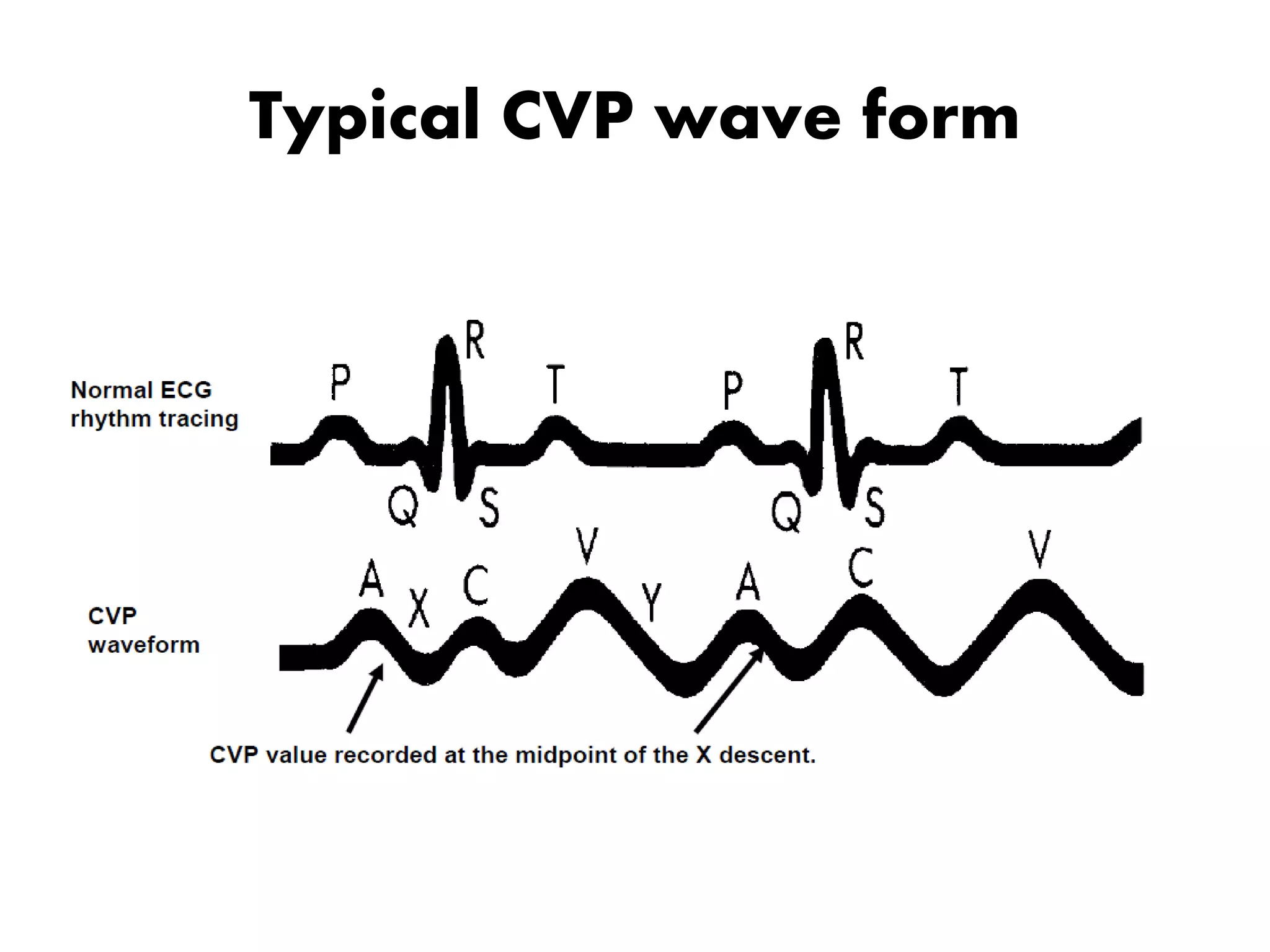 Typical CVP wave form
 