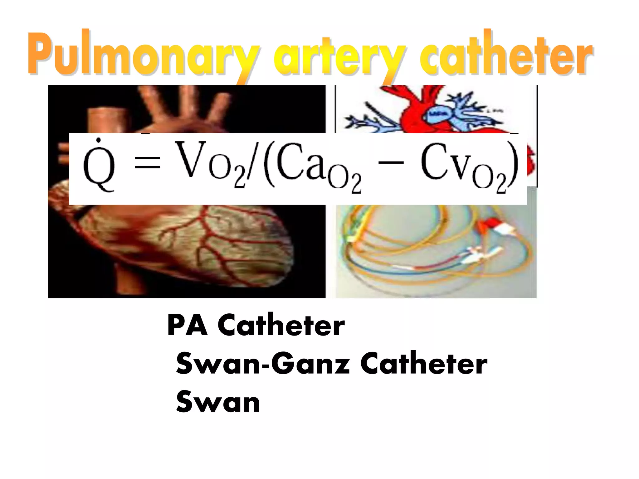 PA Catheter
Swan-Ganz Catheter
Swan
 
