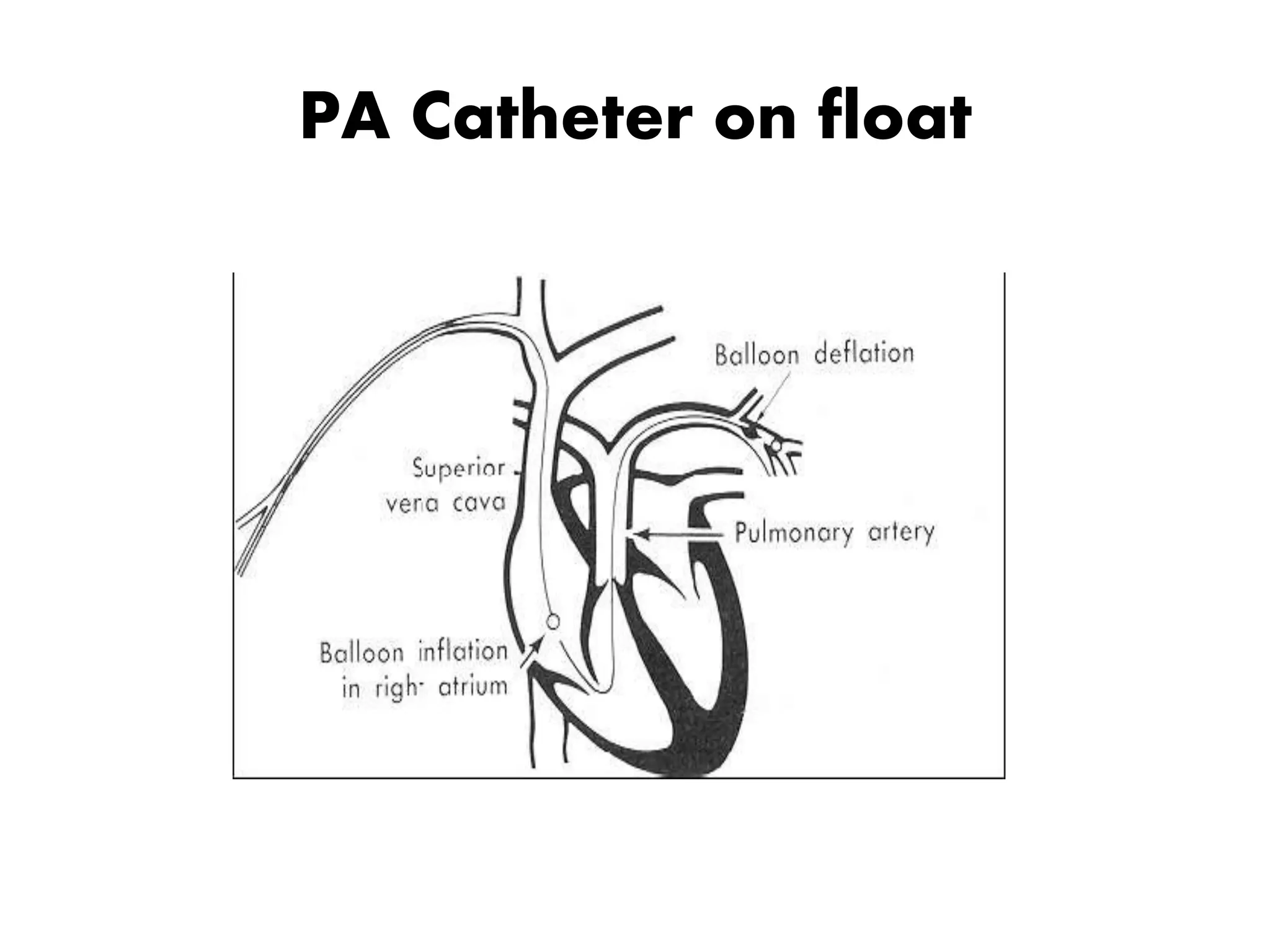 PA Catheter on float
 