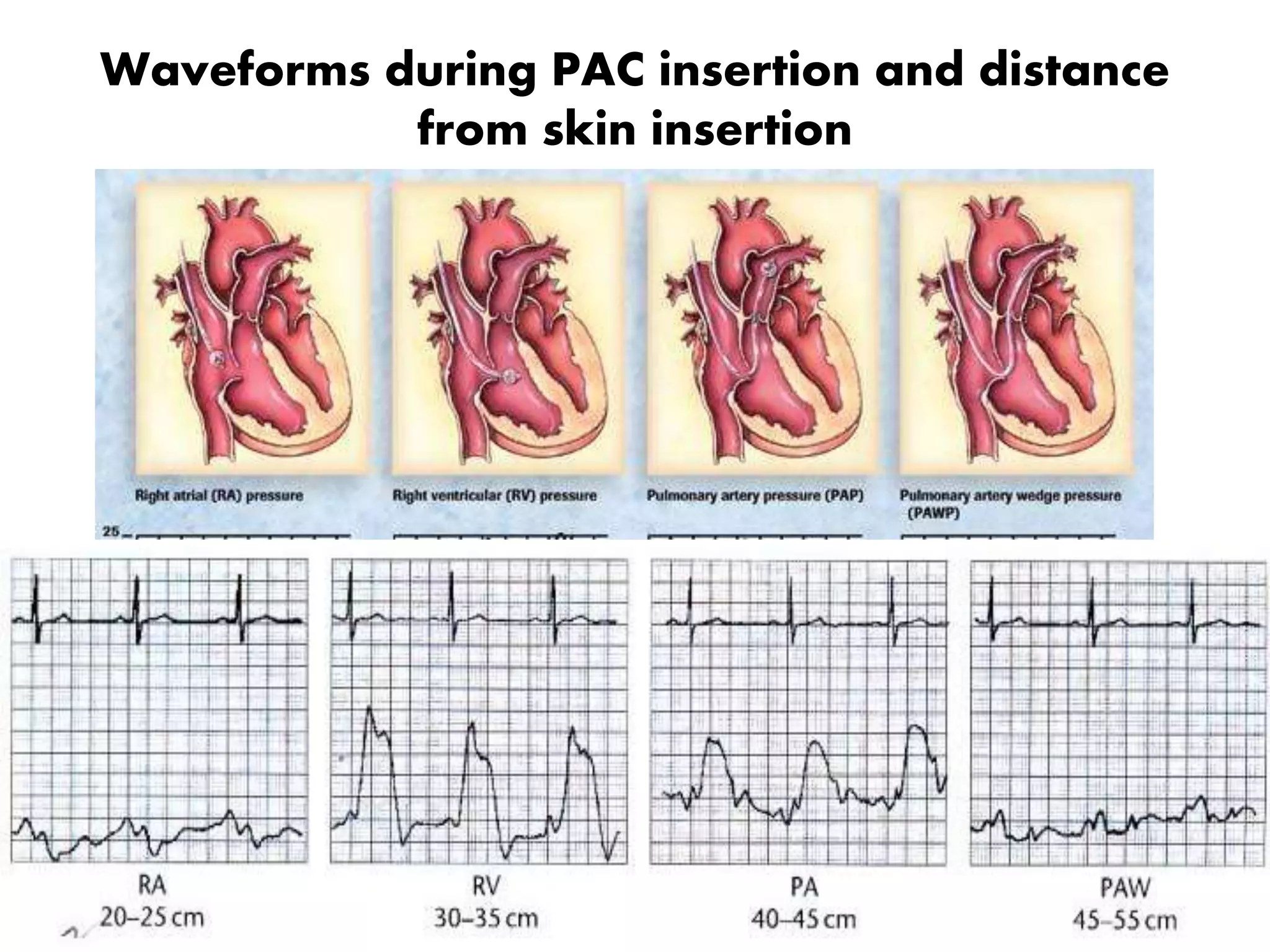 Waveforms during PAC insertion and distance
from skin insertion
 