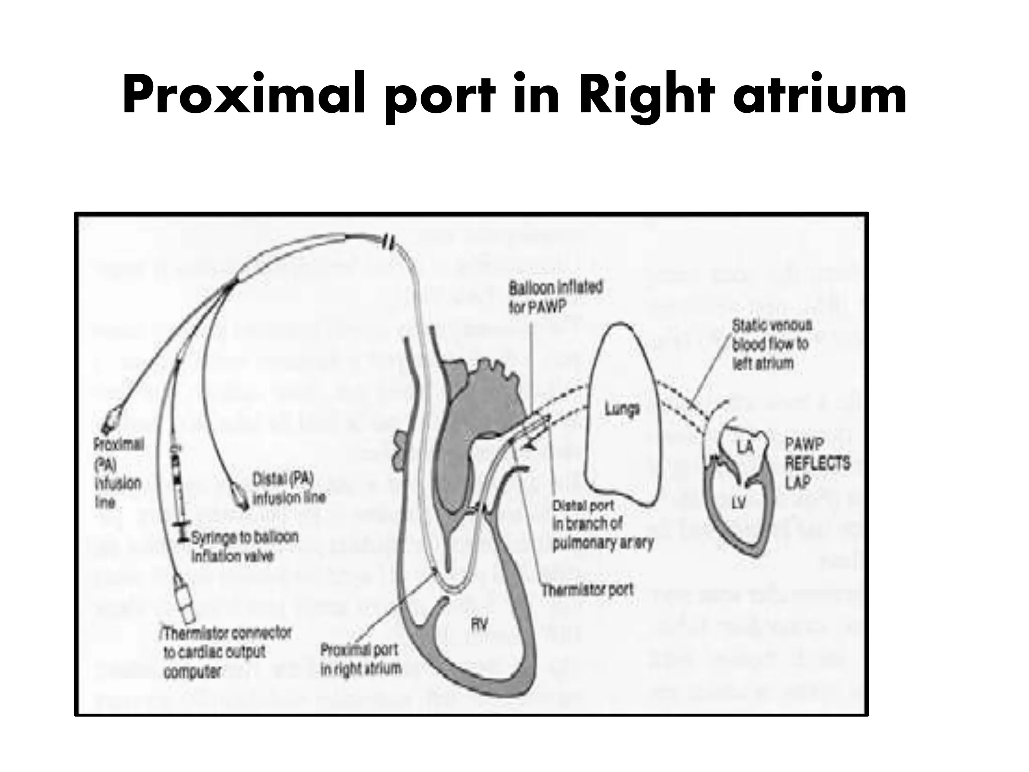 Proximal port in Right atrium
 