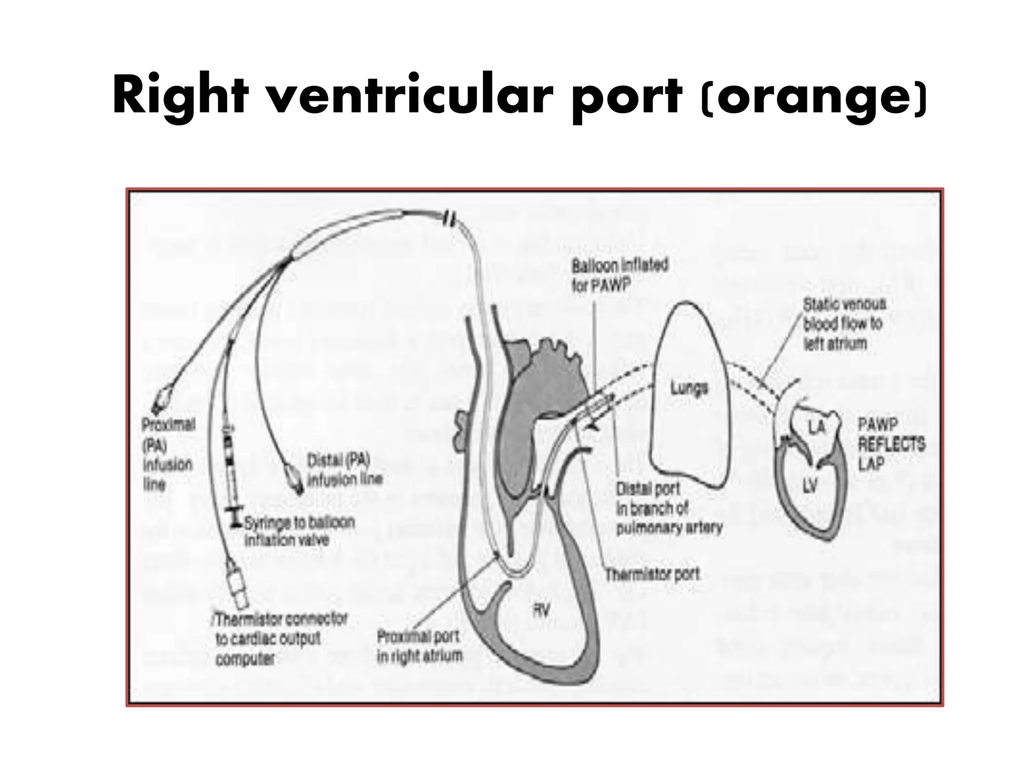 Right ventricular port (orange)
 