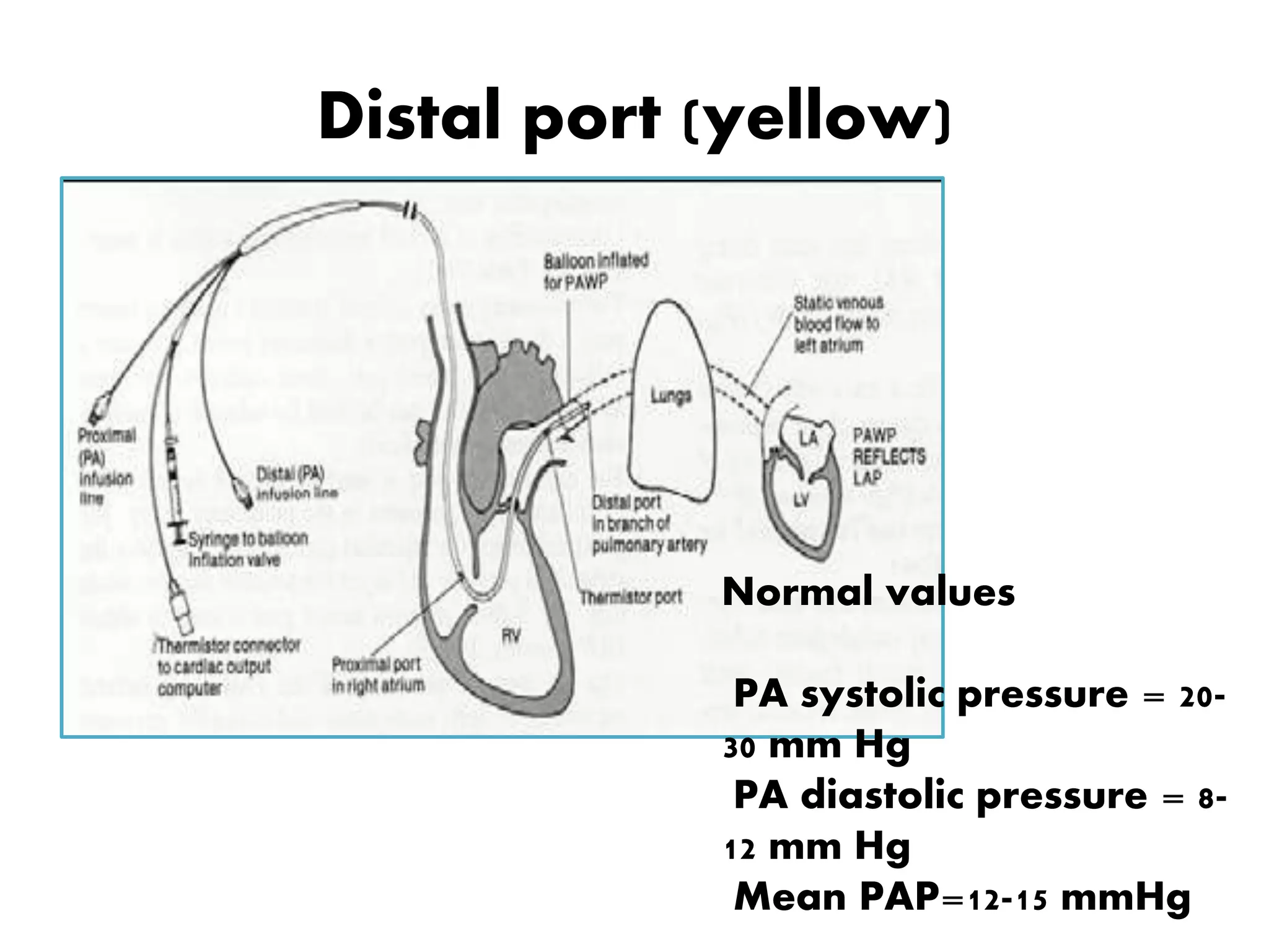 Distal port (yellow)
Normal values
PA systolic pressure = 20-
30 mm Hg
PA diastolic pressure = 8-
12 mm Hg
Mean PAP=12-15 mmHg
 