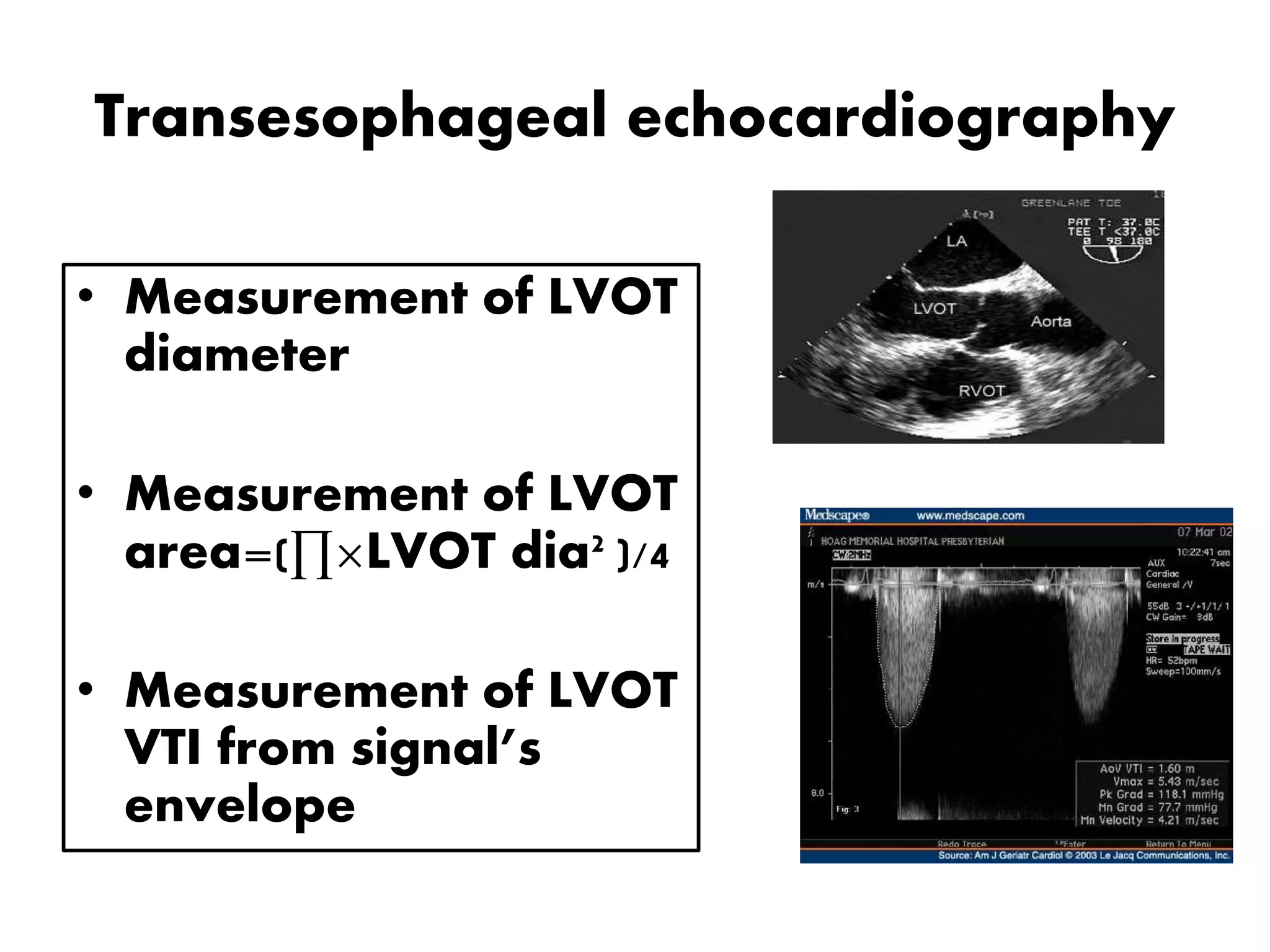 Transesophageal echocardiography
• Measurement of LVOT
diameter
• Measurement of LVOT
area=(∏×LVOT dia2 )/4
• Measurement of LVOT
VTI from signal’s
envelope
 