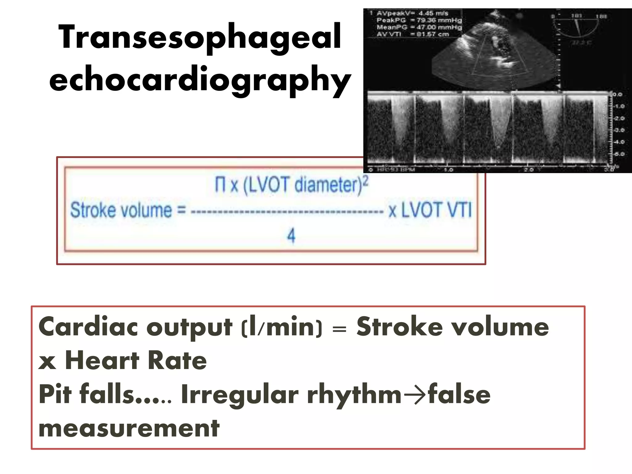 Transesophageal
echocardiography
Cardiac output (l/min) = Stroke volume
x Heart Rate
Pit falls….. Irregular rhythm→false
measurement
 