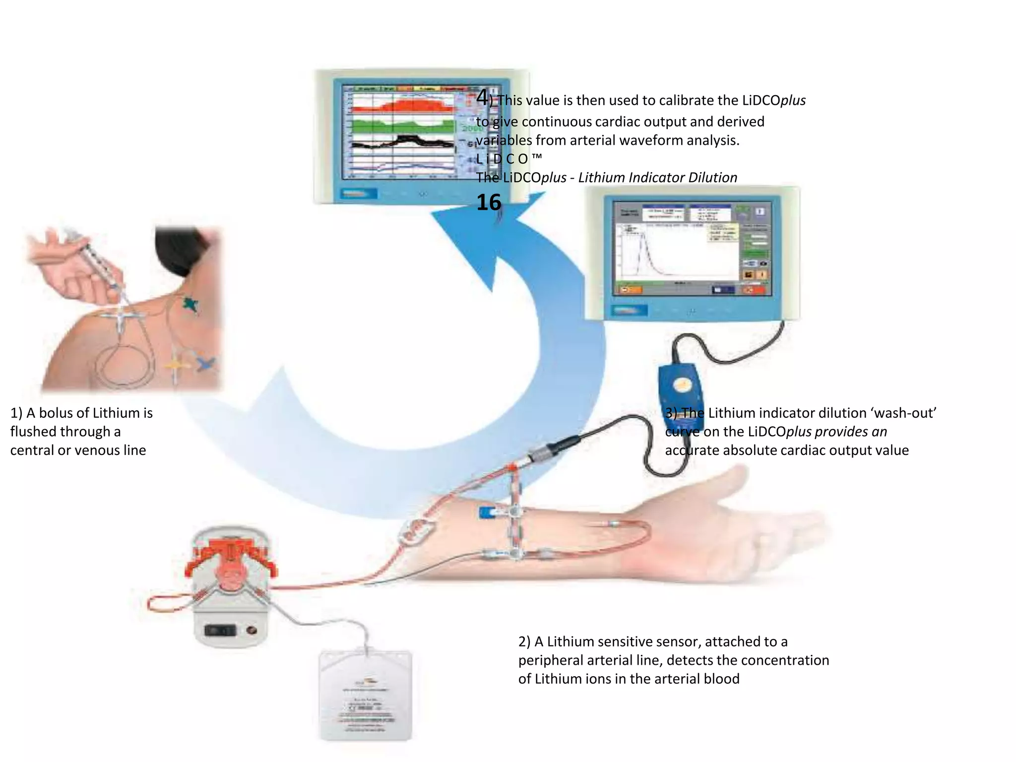 1) A bolus of Lithium is
flushed through a
central or venous line
2) A Lithium sensitive sensor, attached to a
peripheral arterial line, detects the concentration
of Lithium ions in the arterial blood
4) This value is then used to calibrate the LiDCOplus
to give continuous cardiac output and derived
variables from arterial waveform analysis.
L i D C O ™
The LiDCOplus - Lithium Indicator Dilution
16
3) The Lithium indicator dilution ‘wash-out’
curve on the LiDCOplus provides an
accurate absolute cardiac output value
 