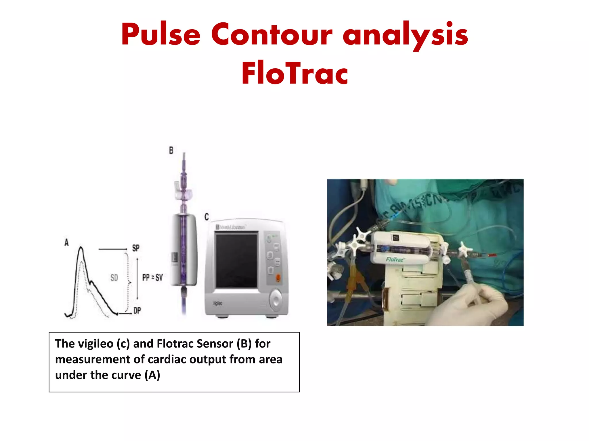 Pulse Contour analysis
FloTrac
The vigileo (c) and Flotrac Sensor (B) for
measurement of cardiac output from area
under the curve (A)
 