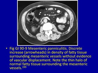 90 fatty lesions in the abdomen and pelvis | PPTX