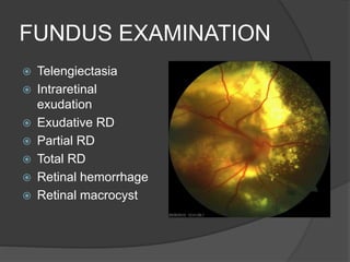 FUNDUS EXAMINATION
 Telengiectasia
 Intraretinal
exudation
 Exudative RD
 Partial RD
 Total RD
 Retinal hemorrhage
 Retinal macrocyst
 