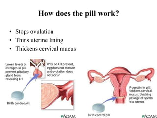 How does the pill work?
• Stops ovulation
• Thins uterine lining
• Thickens cervical mucus
 
