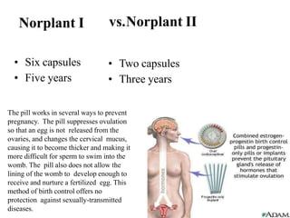 Norplant I vs.Norplant II
• Two capsules
• Three years
• Six capsules
• Five years
The pill works in several ways to prevent
pregnancy. The pill suppresses ovulation
so that an egg is not released from the
ovaries, and changes the cervical mucus,
causing it to become thicker and making it
more difficult for sperm to swim into the
womb. The pill also does not allow the
lining of the womb to develop enough to
receive and nurture a fertilized egg. This
method of birth control offers no
protection against sexually-transmitted
diseases.
 