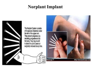 Norplant Implant
 