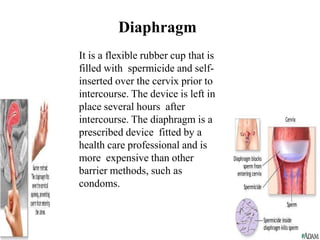 Diaphragm
It is a flexible rubber cup that is
filled with spermicide and self-
inserted over the cervix prior to
intercourse. The device is left in
place several hours after
intercourse. The diaphragm is a
prescribed device fitted by a
health care professional and is
more expensive than other
barrier methods, such as
condoms.
 