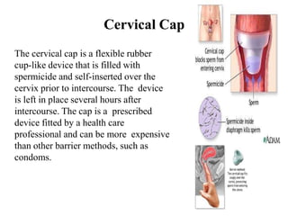 Cervical Cap
The cervical cap is a flexible rubber
cup-like device that is filled with
spermicide and self-inserted over the
cervix prior to intercourse. The device
is left in place several hours after
intercourse. The cap is a prescribed
device fitted by a health care
professional and can be more expensive
than other barrier methods, such as
condoms.
 