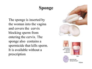 Sponge
The sponge is inserted by
the woman into the vagina
and covers the cervix
blocking sperm from
entering the cervix. The
sponge also contains a
spermicide that kills sperm.
It is available without a
prescription
 
