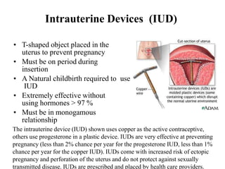 Intrauterine Devices (IUD)
• T-shaped object placed in the
uterus to prevent pregnancy
• Must be on period during
insertion
• A Natural childbirth required to use
IUD
• Extremely effective without
using hormones > 97 %
• Must be in monogamous
relationship
The intrauterine device (IUD) shown uses copper as the active contraceptive,
others use progesterone in a plastic device. IUDs are very effective at preventing
pregnancy (less than 2% chance per year for the progesterone IUD, less than 1%
chance per year for the copper IUD). IUDs come with increased risk of ectopic
pregnancy and perforation of the uterus and do not protect against sexually
transmitted disease. IUDs are prescribed and placed by health care providers.
 