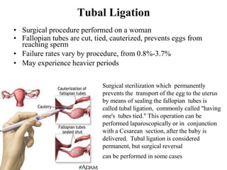Tubal Ligation
• Surgical procedure performed on a woman
• Fallopian tubes are cut, tied, cauterized, prevents eggs from
reaching sperm
• Failure rates vary by procedure, from 0.8%-3.7%
• May experience heavier periods
Surgical sterilization which permanently
prevents the transport of the egg to the uterus
by means of sealing the fallopian tubes is
called tubal ligation, commonly called "having
one's tubes tied." This operation can be
performed laparoscopically or in conjunction
with a Cesarean section, after the baby is
delivered. Tubal ligation is considered
permanent, but surgical reversal
can be performed in some cases
 