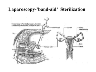 Laparoscopy-’band-aid’ Sterilization
 