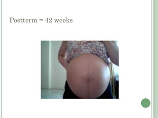 Post Term Management-of-Postterm-Pregnancy | PPT