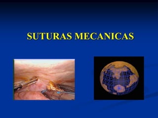 SUTURAS MECANICAS
 