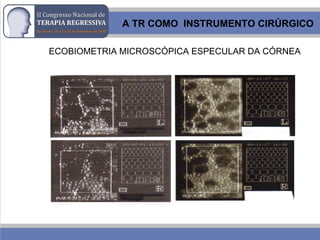 ECOBIOMETRIA MICROSCÓPICA ESPECULAR DA CÓRNEA
A TR COMO INSTRUMENTO CIRÚRGICO
 
