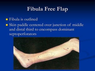 Fibula Free Flap
 Fibula is outlined
 Skin paddle centered over junction of middle
and distal third to encompass dominant
septoperforators
 
