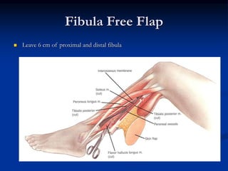 Fibula Free Flap
 Leave 6 cm of proximal and distal fibula
 