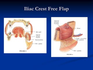 Iliac Crest Free Flap
 