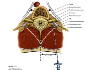 Ultrasound-Guided Thoracic Paravertebral Block | PPTX