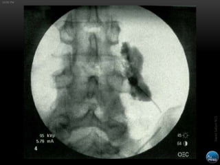 Ultrasound-Guided Thoracic Paravertebral Block | PPTX