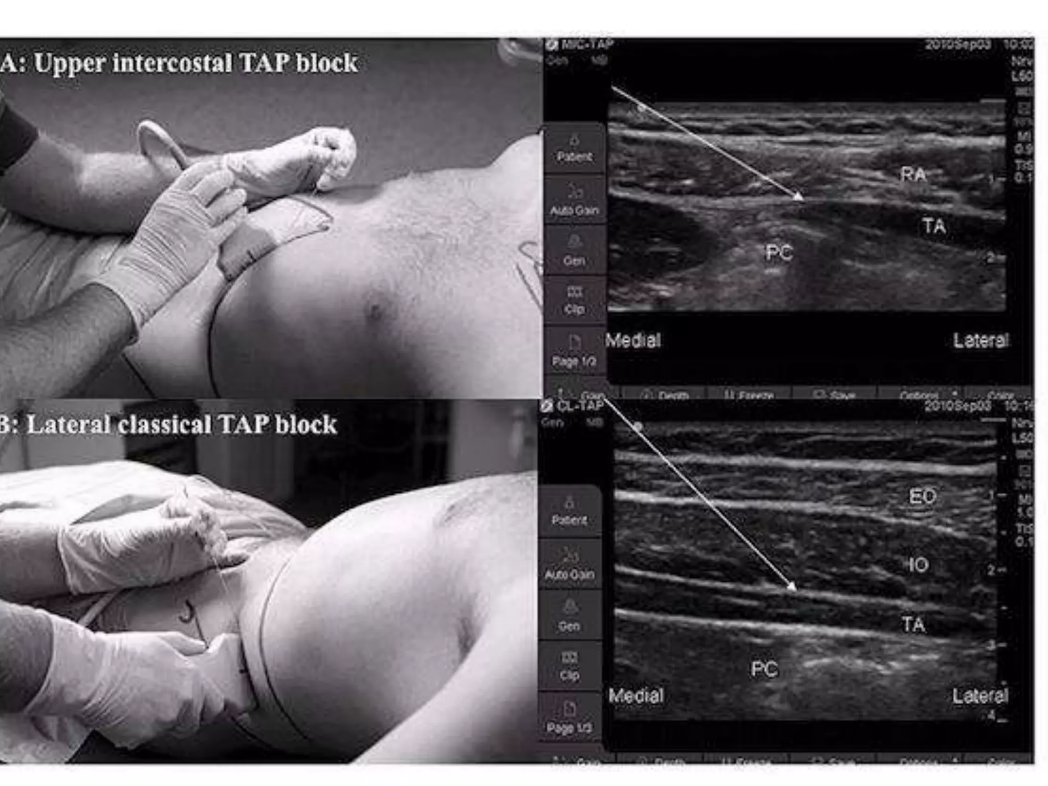 Tap Block Go Ultrasound Guided Transversus Abdominis Plane (TAP) Block | PPTX