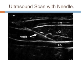 Ultrasound Guided Transversus Abdominis Plane (TAP) Block | PPTX