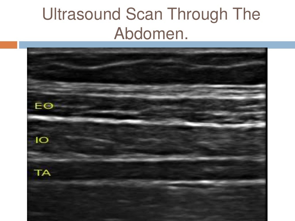 Ultrasound Guided Transversus Abdominis Plane (TAP) Block