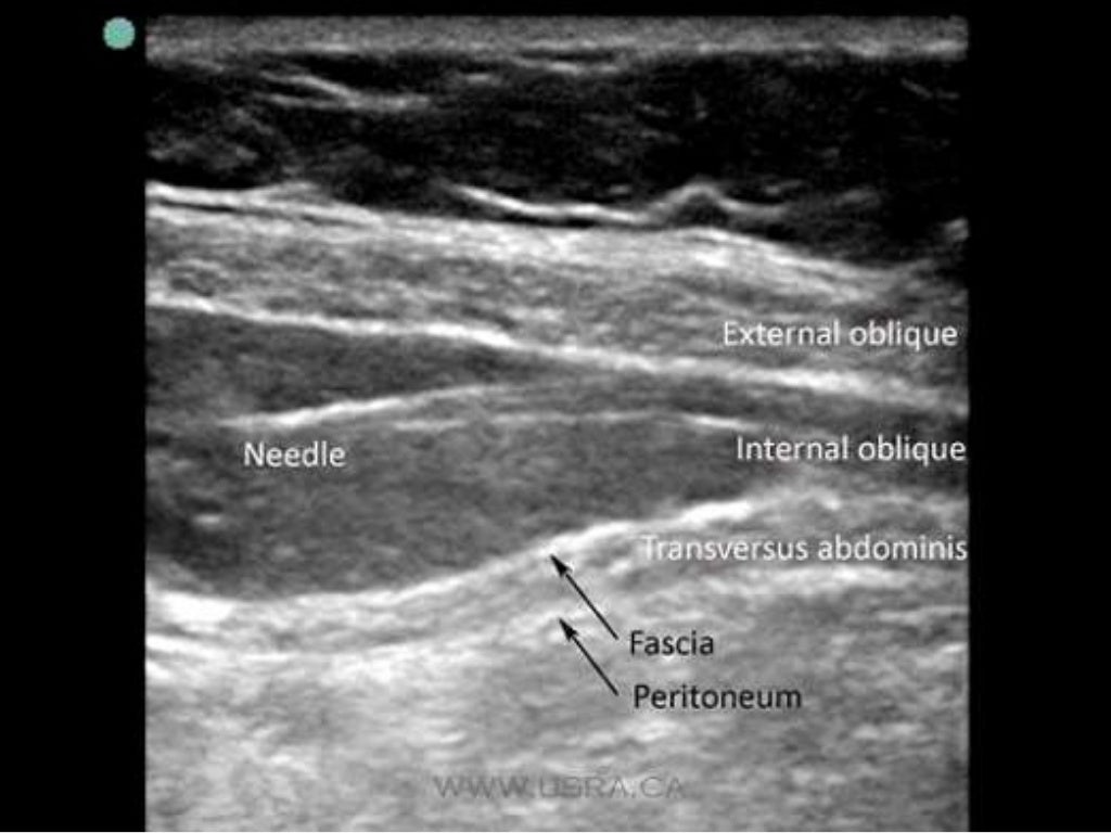 Ultrasound Guided Transversus Abdominis Plane (TAP) Block