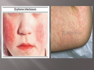 Pediatrics Dematology and rash in common conditiond.ppt