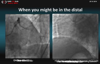 25/ 9/ 2014EURO CTO CLUB
Madrid 2014
3
Sion over CorsairGaia 1 to 2Gaia 3Confianza Pro 12CFZ Pro 12 to XT-R Gaia 1 over Corsair and “ Anchoring Balloon”Gaia 2 for further wiringStep down to Gaia 1IVUS from AC branchXT-R wire over the 2 nd OTW lumen of CrusadeDES deploymentAnother DES + KBT
 