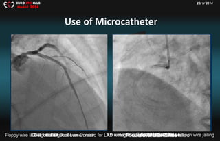 25/ 9/ 2014EURO CTO CLUB
Madrid 2014
Gaia 1 stGaia 1 in Diagonal over CorsairFloppy wire in Diagonal on Dual Lumen micro for LAD wiringXT-R for LAD 7F JR5.0SH2.5 mm ballooning3.5 mm DES deployment with side branch wire jailingGaia 1 over CorsairParallel over Dual Lumen MicroGaia 2 as a 2 nd WireAfter additional 2 DES+ Post
 