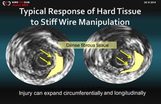 25/ 9/ 2014EURO CTO CLUB
Madrid 2014
Subintimal dissection by Stiff CTO wire manipulation
Dense fibrous tissue
Injury can expand circumferentially and longitudinally
 