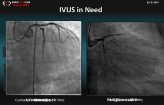 25/ 9/ 2014EURO CTO CLUB
Madrid 2014
XT-R to Gaia 1Gaia 2 to 3Confianza Pro 12Confianza Pro 12 as a 2 nd WireMiracle Neo3g IVUS Guided LAD EntryRetrograde Gaia 1Ant 2.5 mm balloon
 