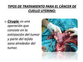 933 cancer de utero 744