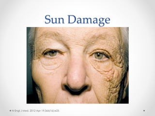 Sun Damage
N Engl J Med. 2012 Apr 19;366(16):e25
 