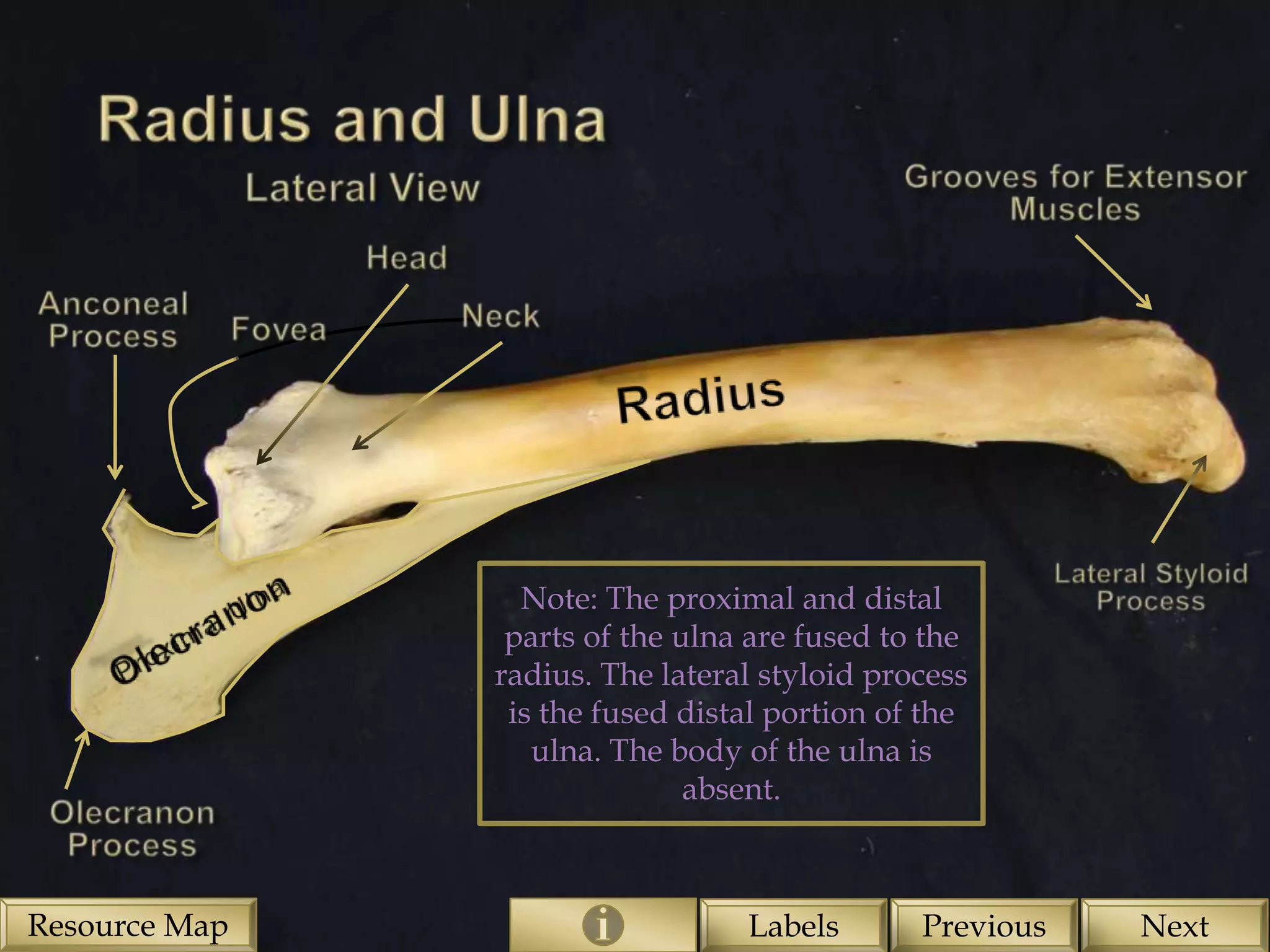 Note: The proximal and distal
                parts of the ulna are fused to the
               radius. The lateral styloid process
                is the fused distal portion of the
                  ulna. The body of the ulna is
                              absent.



Resource Map                     Labels       Previous   Next
 