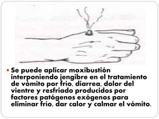  Se puede aplicar moxibustión
interponiendo jengibre en el tratamiento
de vómito por frío, diarrea, dolor del
vientre y resfriado producidos por
factores patógenos exógenos para
eliminar frío, dar calor y calmar el vómito.
 