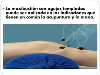  La moxibustión con agujas templadas
puede ser aplicada en las indicaciones que
tienen en común la acupuntura y la moxa.
 
