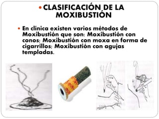  CLASIFICACIÓN DE LA
MOXIBUSTIÓN
 En clínica existen varios métodos de
Moxibustión que son: Moxibustión con
conos; Moxibustión con moxa en forma de
cigarrillos; Moxibustión con agujas
templadas.
 
