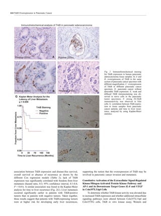 association between TrkB expression and disease-free survival,
overall survival or absence of recurrence as shown by the
different Cox regression models (Table 2), lack of TrkB
expression was significantly correlated with freedom from liver
metastasis (hazard ratio, 0.3; 95% confidence interval, 0.1-0.8;
P = 0.01). A similar association was found in the Kaplan-Meier
analysis for time to liver recurrence (Fig. 2G). Liver metastasis
occurred significantly earlier in patients with TrkB-positive
tumors than in patients with negative tumors. Taken together,
these results suggest that patients with TrkB-expressing tumors
were at higher risk for developing early liver recurrences,
supporting the notion that the overexpression of TrkB may be
involved in pancreatic cancer invasion and metastasis.
Constitutive Activation of the Extracellular Signal-Regulated
Kinase-Mitogen-Activated Protein Kinase Pathway and
AP-1 and its Downstream Target Genes IL-8 and VEGF
in Colo357L3.6pl Cells
To determine whether TrkB kinase activity was elevated due
to increased TrkB expression and whether additional intracellular
signaling pathways were altered between Colo357L3.6pl and
Colo357FG cells, TrkB in vitro kinase assay, Western and
Fig. 2 Immunohistochemical staining
for TrkB expression in human pancreatic
adenocarcinoma tissue samples. In A and
B, overexpression of TrkB in the same
section of pancreatic cancer specimen with
different magnification. C, overexpression
of TrkB in different pancreatic cancer
specimen. D, pancreatic cancer without
detectable TrkB expression. E, weak and
diffused TrkB immunostaining was ob-
served in nerve cells in the pancreatic
tumor specimens. F, strong 28.TrkB
immunoactivity was observed in Islet
cells. G, correlation between TrkB expres-
sion in tissue samples from pancreatic
cancer patients and time to liver recur-
rence, analyzed by using Kaplan-Meier
statistics.
TrkB Overexpression in Pancreatic Cancer444
 