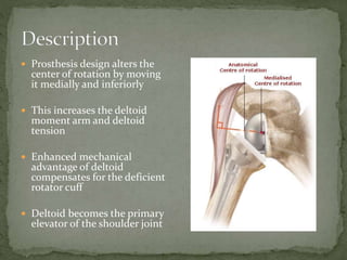  Prosthesis design alters the
center of rotation by moving
it medially and inferiorly
 This increases the deltoid
moment arm and deltoid
tension
 Enhanced mechanical
advantage of deltoid
compensates for the deficient
rotator cuff
 Deltoid becomes the primary
elevator of the shoulder joint
 