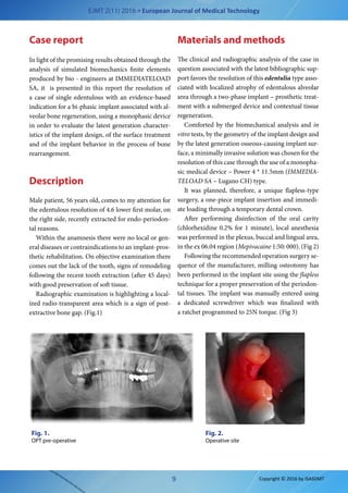 EJMT 2(11) 2016 • European Journal of Medical Technology
9 Copyright © 2016 by ISASDMT
Case report
In light of the promising results obtained through the
analysis of simulated biomechanics finite elements
produced by bio - engineers at IMMEDIATELOAD
SA, it is presented in this report the resolution of
a case of single edentulous with an evidence-based
indication for a bi-phasic implant associated with al-
veolar bone regeneration, using a monophasic device
in order to evaluate the latest generation character-
istics of the implant design, of the surface treatment
and of the implant behavior in the process of bone
rearrangement.
Description
Male patient, 56 years old, comes to my attention for
the edentulous resolution of 4.6 lower first molar, on
the right side, recently extracted for endo-periodon-
tal reasons.
Within the anamnesis there were no local or gen-
eral diseases or contraindications to an implant-pros-
thetic rehabilitation. On objective examination there
comes out the lack of the tooth, signs of remodeling
following the recent tooth extraction (after 45 days)
with good preservation of soft tissue.
Radiographic examination is highlighting a local-
ized ​​radio-transparent area which is a sign of post-
extractive bone gap. (Fig.1)
Materials and methods
The clinical and radiographic analysis of the case in
question associated with the latest bibliographic sup-
port favors the resolution of this edentulia type asso-
ciated with localized atrophy of edentulous alveolar
area through a two-phase implant – prosthetic treat-
ment with a submerged device and contextual tissue
regeneration.
Comforted by the biomechanical analysis and in
vitro tests, by the geometry of the implant design and
by the latest generation osseous-causing implant sur-
face, a minimally invasive solution was chosen for the
resolution of this case through the use of a monopha-
sic medical device – Power 4 * 11.5mm (IMMEDIA-
TELOAD SA – Lugano CH) type.
It was planned, therefore, a  unique flapless-type
surgery, a one-piece implant insertion and immedi-
ate loading through a temporary dental crown.
After performing disinfection of the oral cavity
(chlorhexidine 0.2% for 1 minute), local anesthesia
was performed in the plexus, buccal and lingual area,
in the ex 06.04 region (Mepivacaine 1:50: 000). (Fig 2)
Following the recommended operation surgery se-
quence of the manufacturer, milling osteotomy has
been performed in the implant site using the flapless
technique for a proper preservation of the periodon-
tal tissues. The implant was manually entered using
a  dedicated screwdriver which was finalized with
a ratchet programmed to 25N torque. (Fig 3)
Fig. 1.
OPT pre-operative
Fig. 2.
Operative site
 