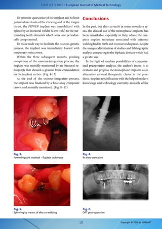 EJMT 2(11) 2016 • European Journal of Medical Technology
10 Copyright © 2016 by ISASDMT
Fig. 3.
Power Implant inserted – flapless technique
Fig. 4.
Rx intra-operative
Fig. 5.
Splinting by means of electro-welding
To promote quiescence of the implant and to limit
potential overloads of the chewing and of the tongue
thrust, the POWER implant was immobilized with
splints by an intraoral welder (DentWeld) to the sur-
rounding teeth elements which were not periodon-
tally compromised.
To make such way to facilitate the osseous-genetic
process, the implant was immediately loaded with
temporary resin crown.
Within the three subsequent months, pending
completion of the osseous-integration process, the
implant was monthly monitored by an intraoral ra-
diograph that showed a gradual bone consolidation
on the implant surface. (Fig. 4-13)
At the end of the osseous-integrative process,
the implant was finalized by a final alloy-composite
crown and annually monitored. (Fig 14-17)
Conclusions
In the past, but also currently in some nowadays ar-
eas, the clinical use of the monophasic implants has
been remarkable, especially in Italy, where the one-
piece implant technique associated with intraoral
welding had its birth and its most widespread, despite
the unequal distribution of studies and bibliographic
analysis comparing to the biphasic devices which had
a greater use.
In the light of modern possibilities of computer-
ized preoperative analysis, the author's intent is to
evaluate and propose the monophasic implants as an
alternative rational therapeutic choice in the pros-
thetic-implant rehabilitation with the help of modern
knowledge and technology currently available of the
Fig. 6.
OPT post-operative
 