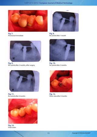 EJMT 2(11) 2016 • European Journal of Medical Technology
11 Copyright © 2016 by ISASDMT
Fig. 7.
Provisional immediate
Fig. 8.
Rx control after 1 month
Fig. 9.
RX control after 2 months, after surgery
Fig. 10.
Rx control after 3 months
Fig. 11.
Rx control after 4 months
Fig. 12.
Clinic view after 4 months
Fig. 13.
Final crown
 